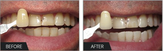 Zoom Whitening California