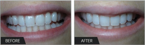 Dental Bonding California