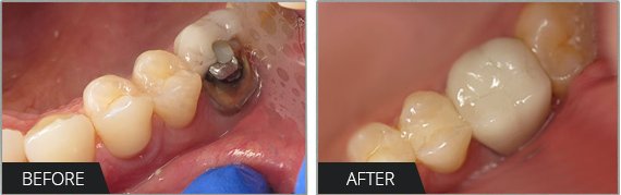 Dental Crowns California