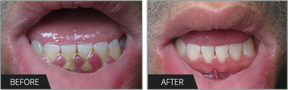 Dental Cleaning Los Angeles