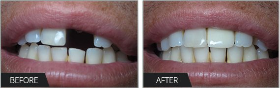 Dental Crown Implant Los Angeles