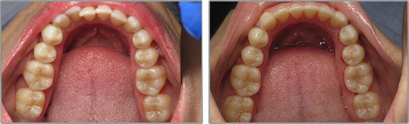 Invisalign. Before and After Photos: Patient 5 - frontal view